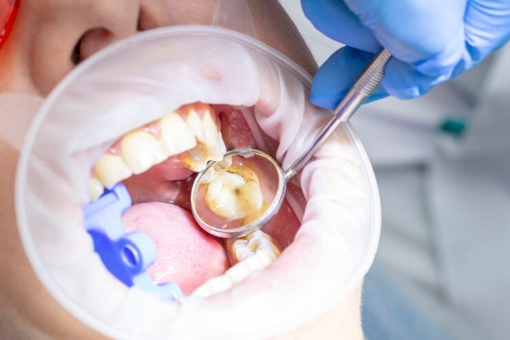Composite Fillings in Bowmanville