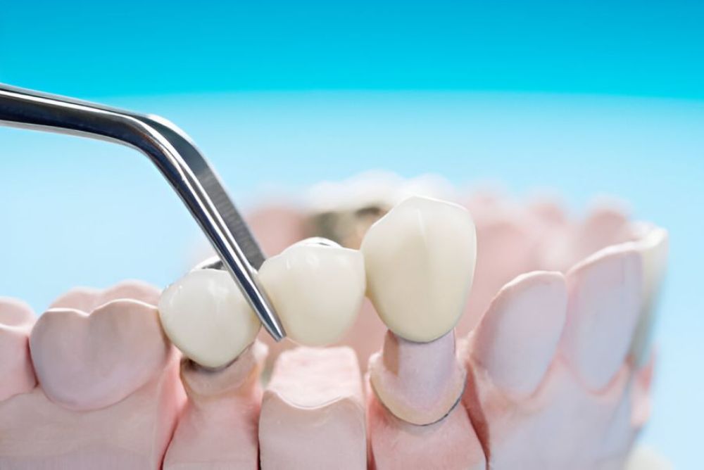 Dental Bridges in Bowmanville