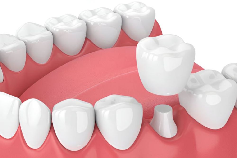 Dental Crowns in Bowmanville