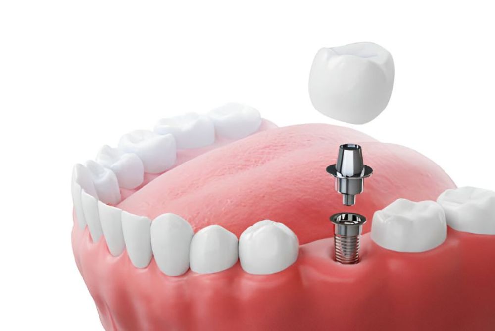 Dental Impants in Bowmanville