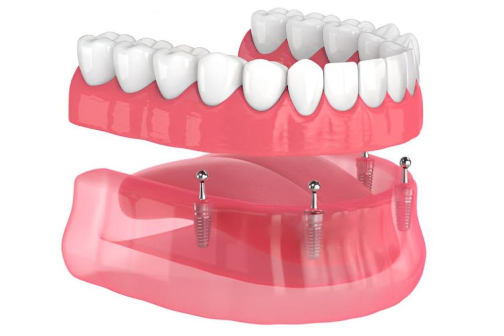 Implant Supported Dentures in Bowmanville