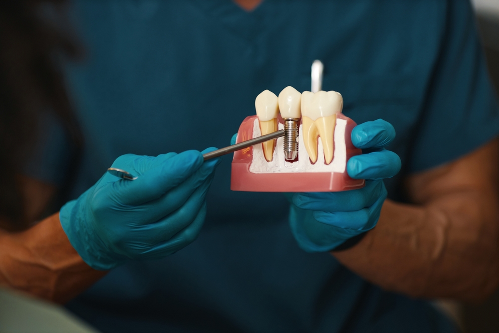 dental implants cost and covered under a canadian dental care plan